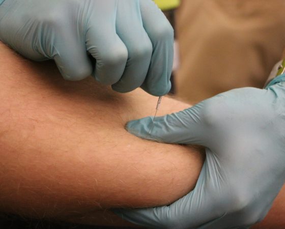 Functional Dry Needling Now Available