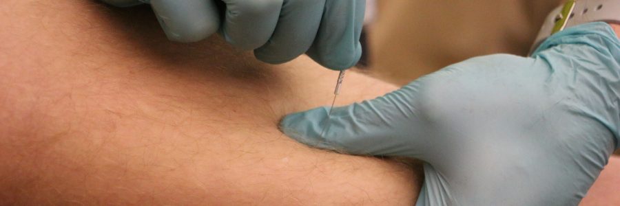 Functional Dry Needling Now Available